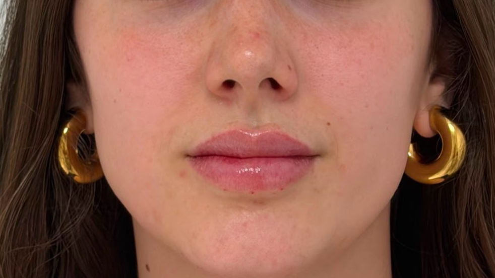 Antes del tratamiento facial