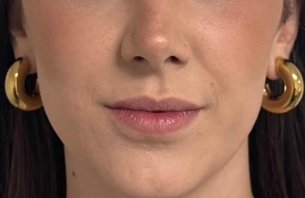 Después del tratamiento facial