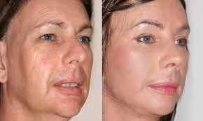 Caso ilustrativo de evolución facial antes y después del tratamiento