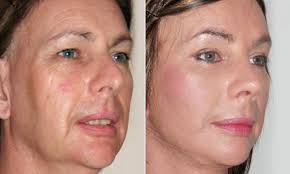Caso ilustrativo de evolución facial antes y después del tratamiento