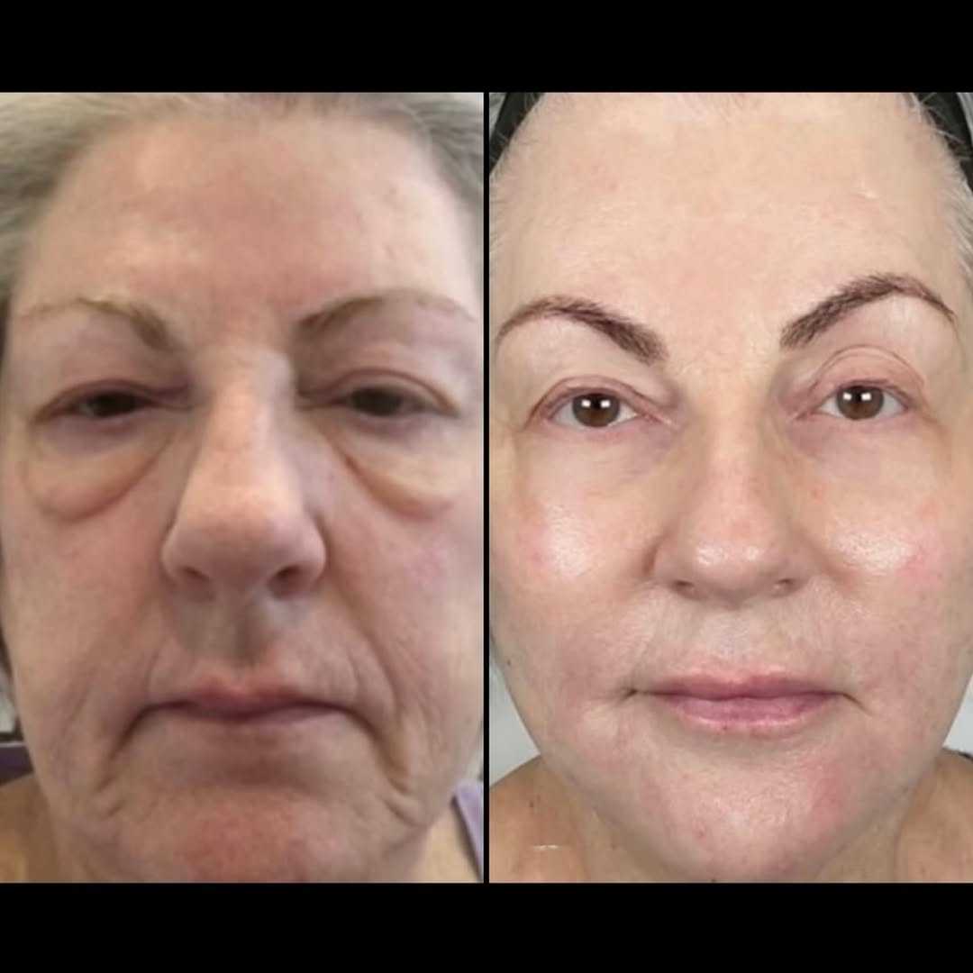 Caso ilustrativo de evolución facial antes y después del tratamiento
