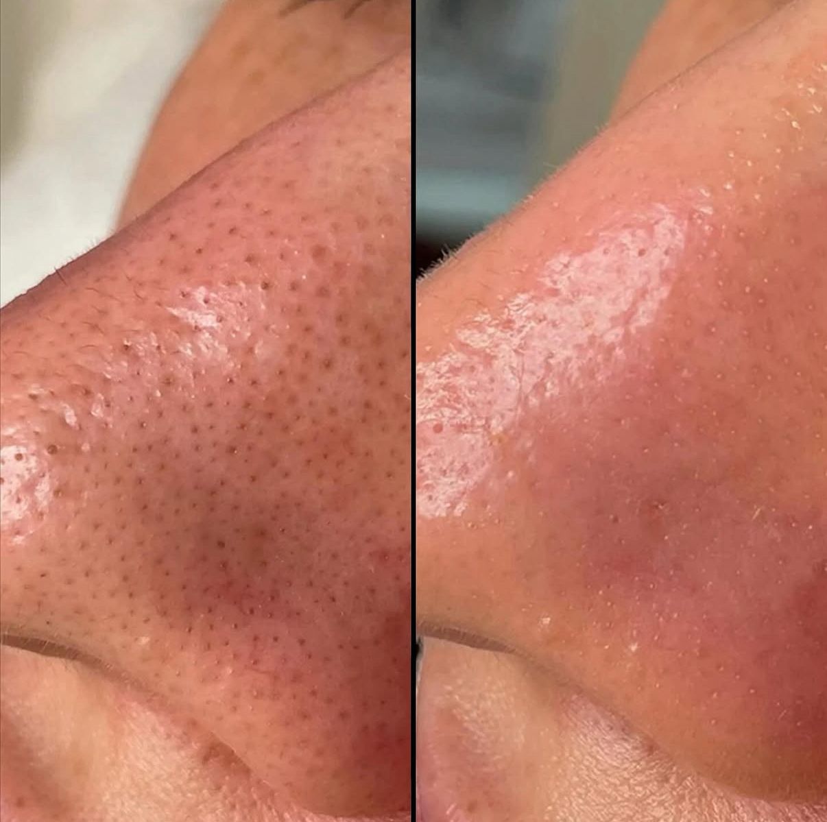 Tratamiento Hydrafacial en clínica