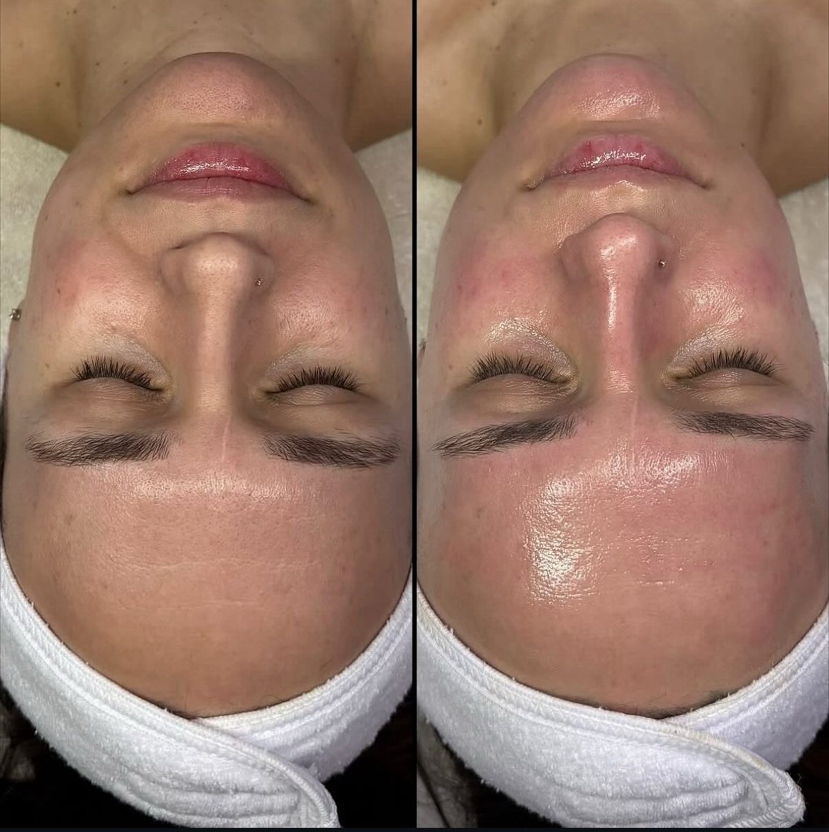Caso ilustrativo de evolución facial antes y después del tratamiento
