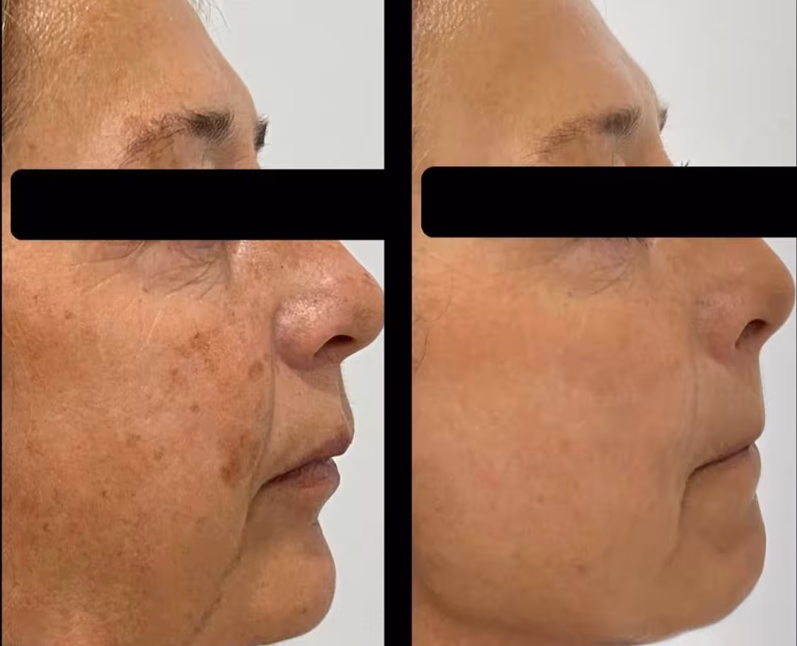 Tratamiento IPL en clínica
