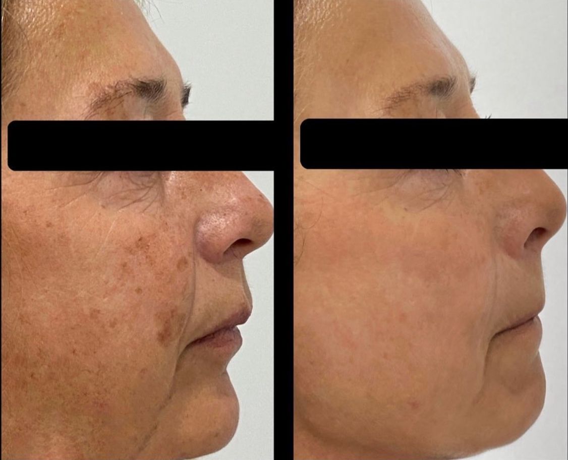 Tratamiento IPL en clínica