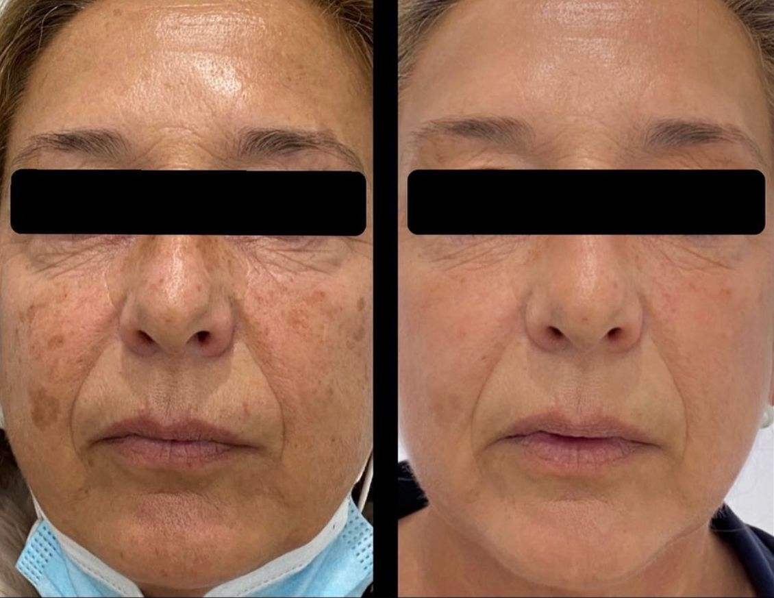 Antes y después de tratamiento IPL en vista frontal