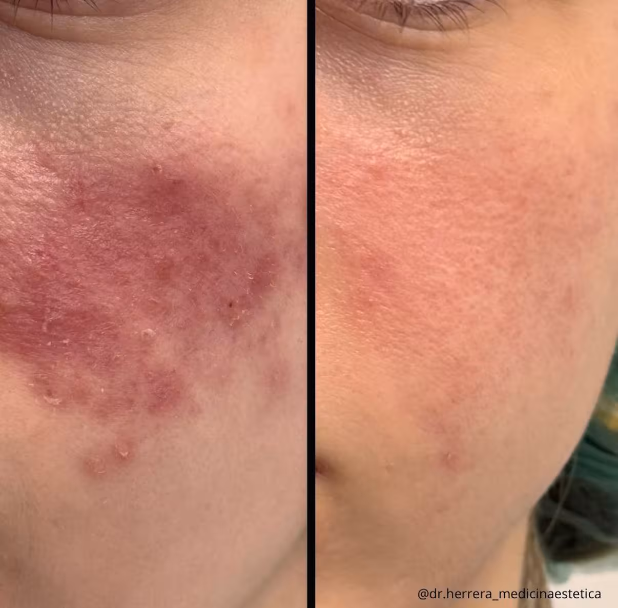 Antes y después de tratamiento IPL en detalle facial