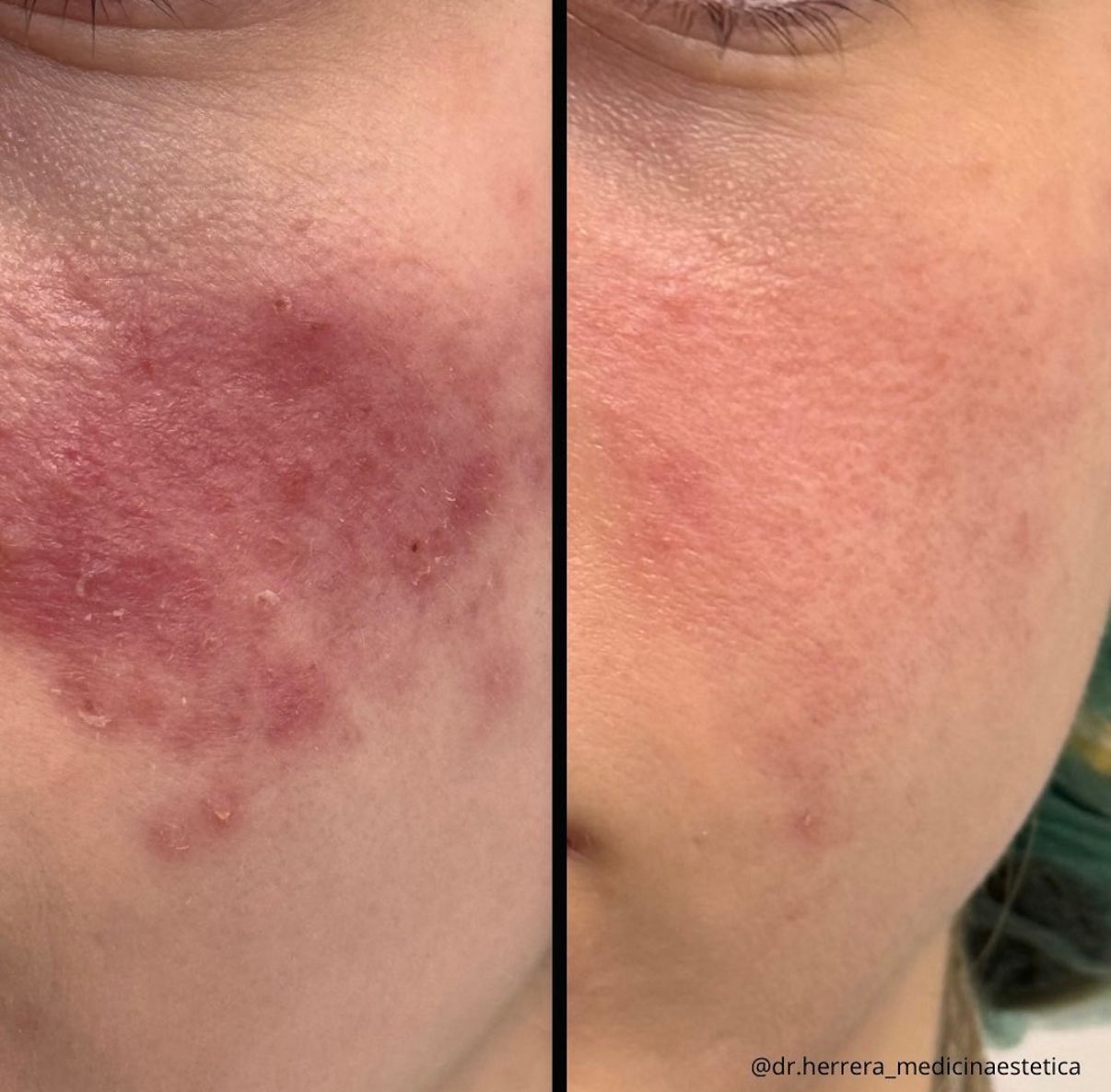 Antes y después de tratamiento IPL en detalle facial