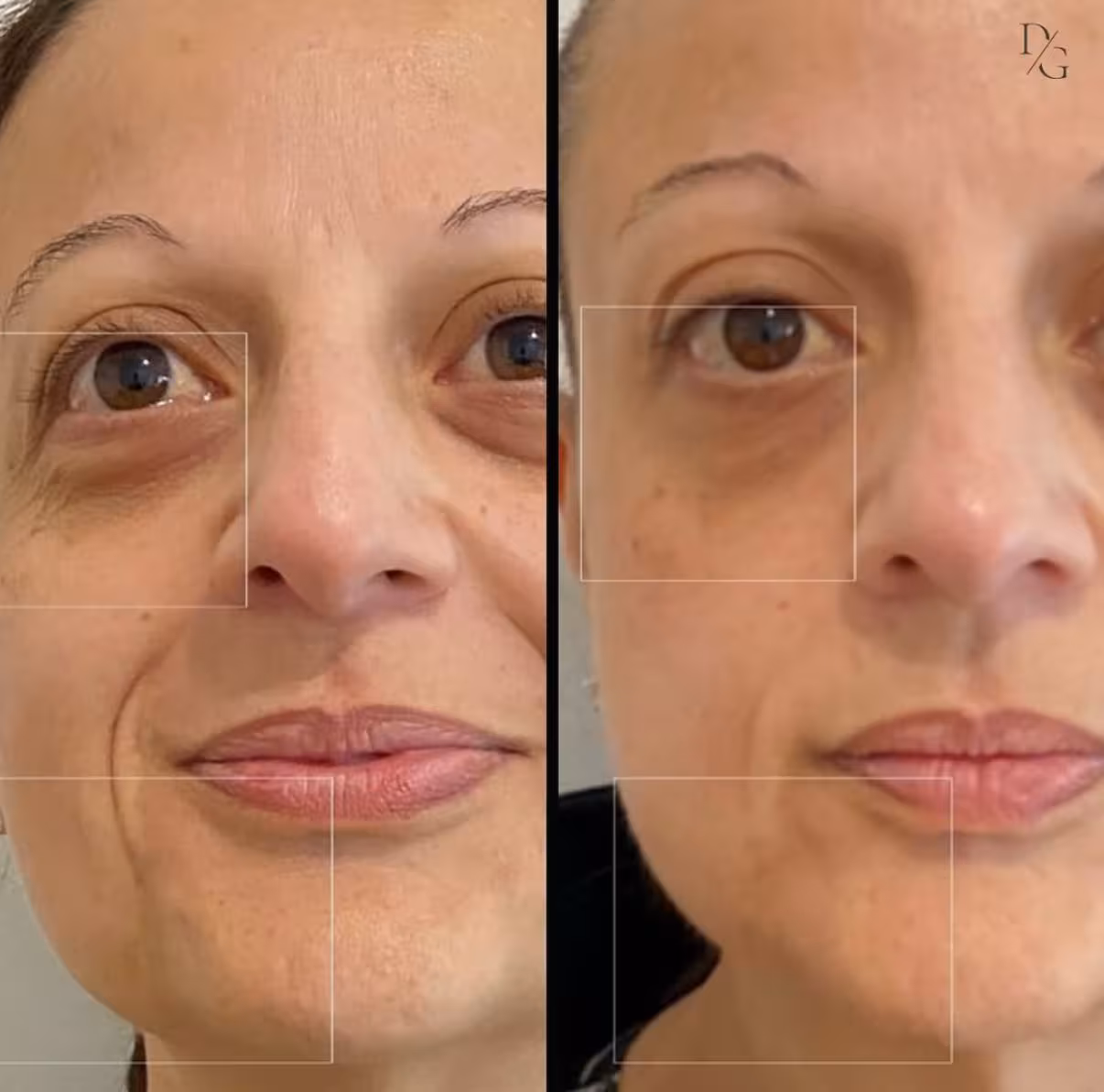 Antes y después de Wonder Face en vista frontal