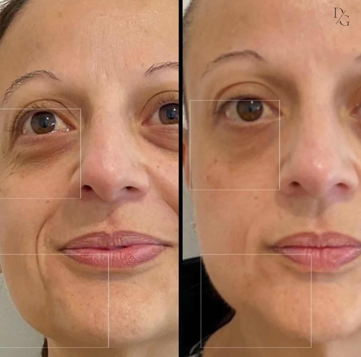 Antes y después de Wonder Face en vista frontal