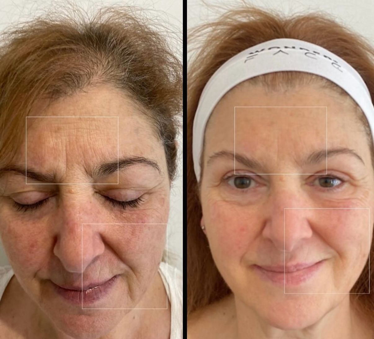 Antes y después de Wonder Face en otra vista