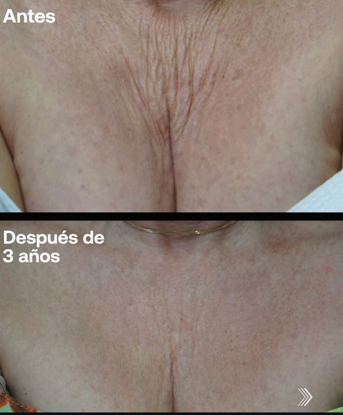 Antes y después de inductores de colágeno en vista lateral