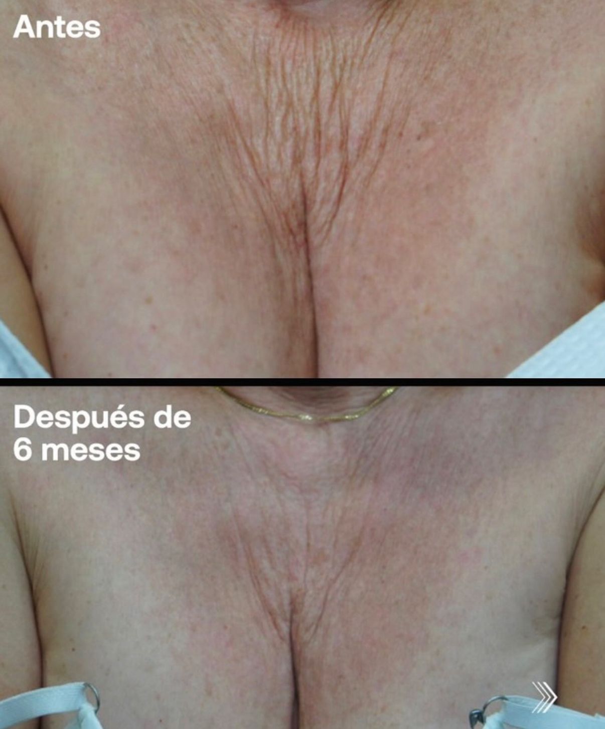 Antes y después de inductores de colágeno en otra vista