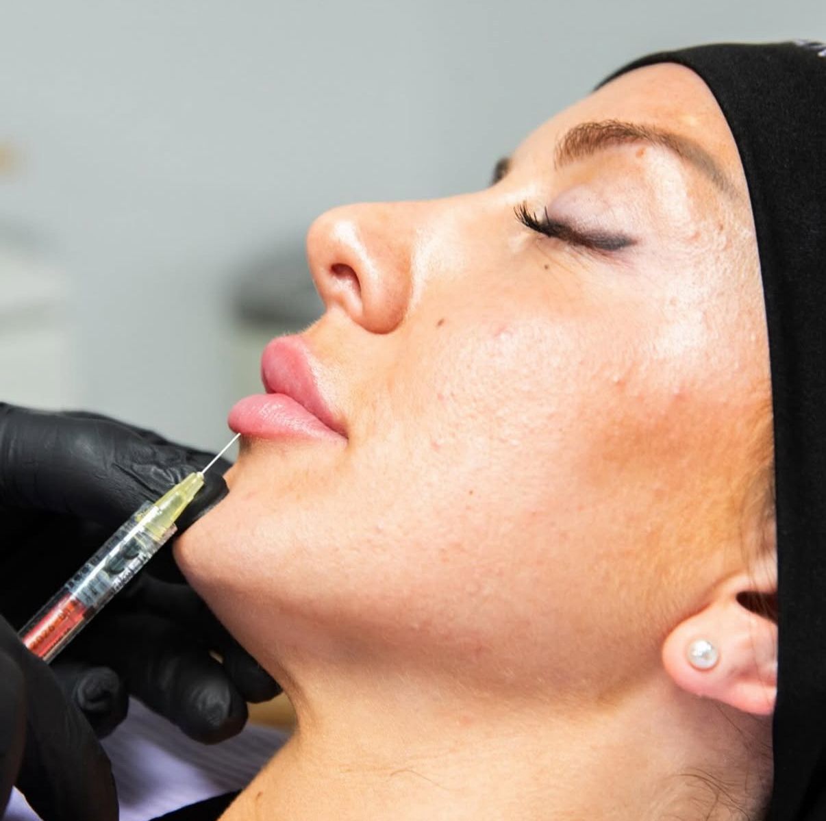 Tratamiento de aumento de labios en clínica