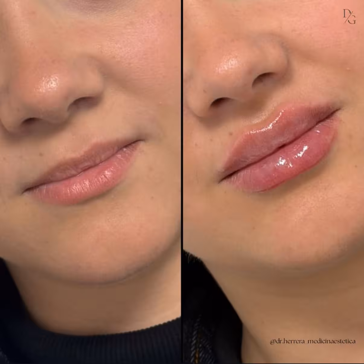 Antes y después de aumento de labios en vista lateral