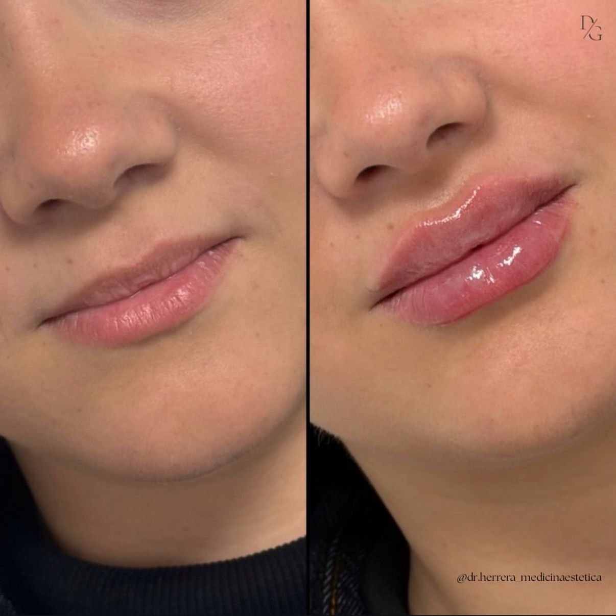 Antes y después de aumento de labios en vista lateral
