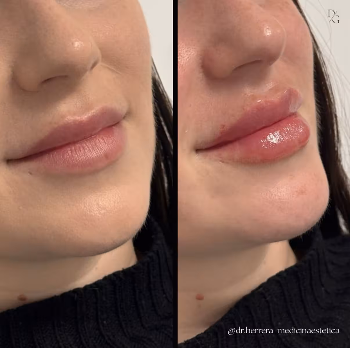 Antes y después de aumento de labios en otra vista lateral