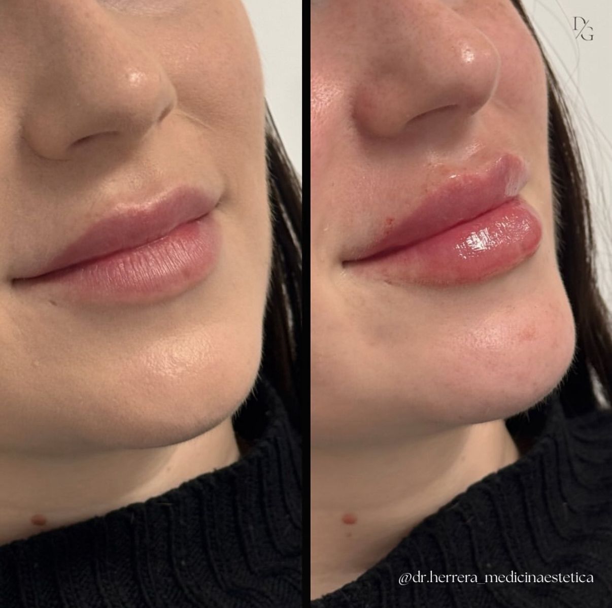 Antes y después de aumento de labios en otra vista lateral