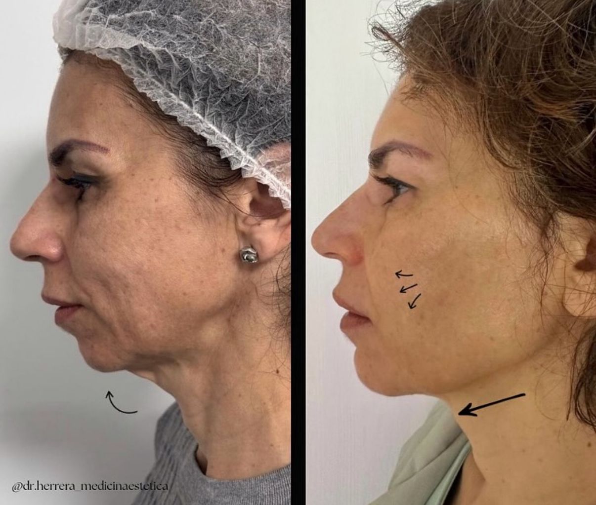 Antes y después de lifting sin cirugía