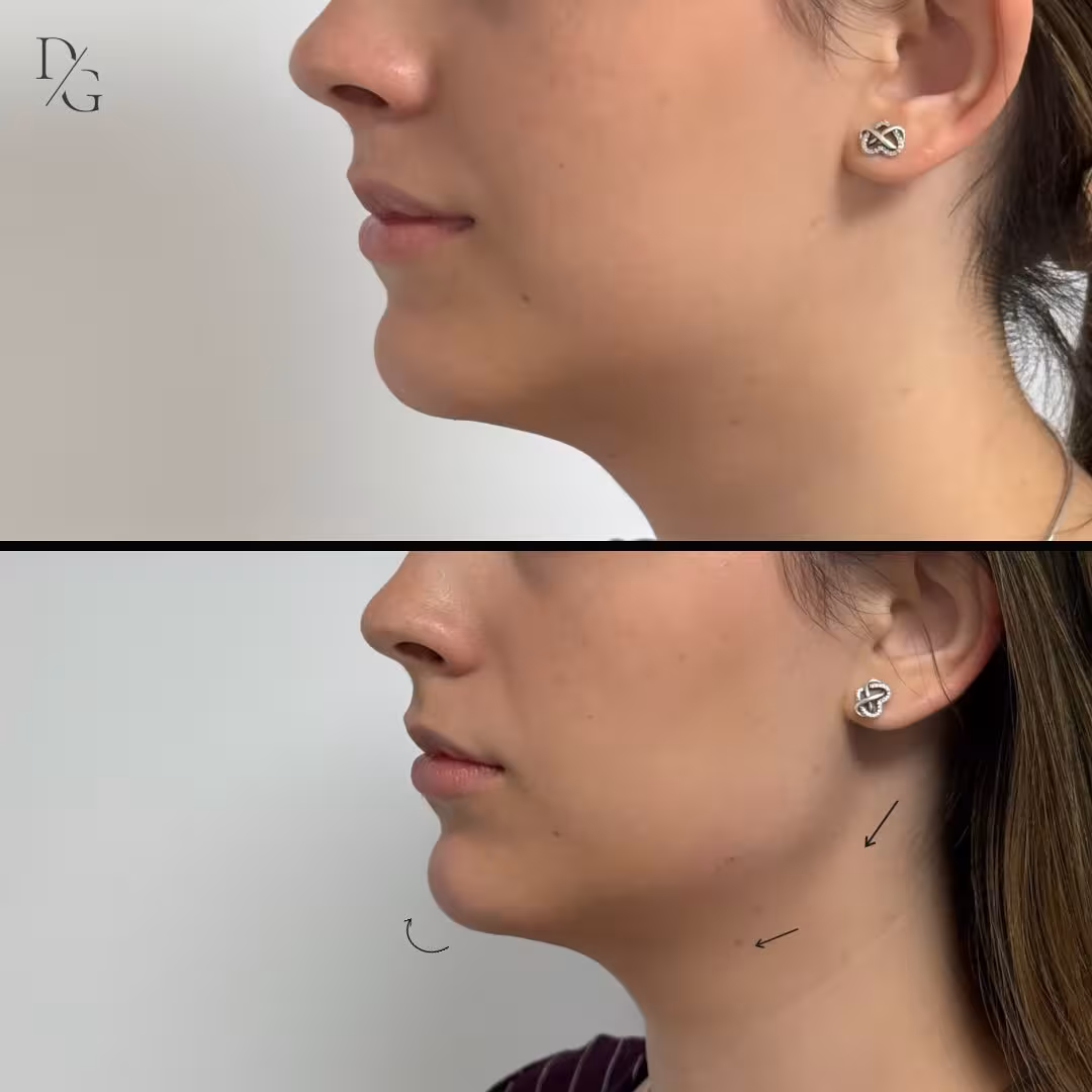 Antes y después de marcación mandibular en vista lateral