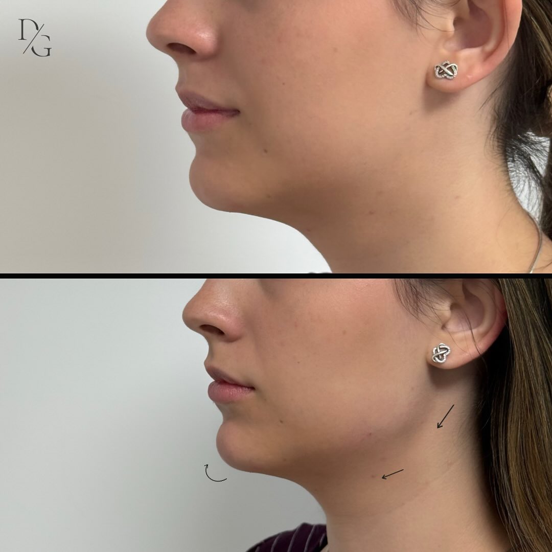 Antes y después de marcación mandibular en vista lateral