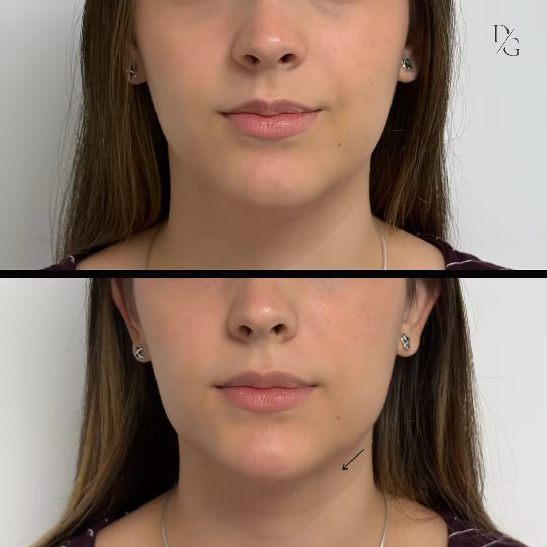 Antes y después de marcación mandibular en vista frontal
