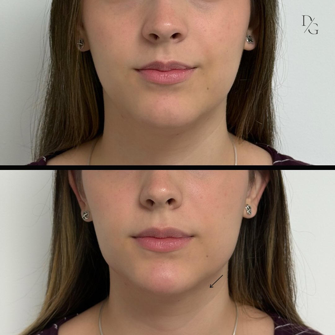 Antes y después de marcación mandibular en vista frontal
