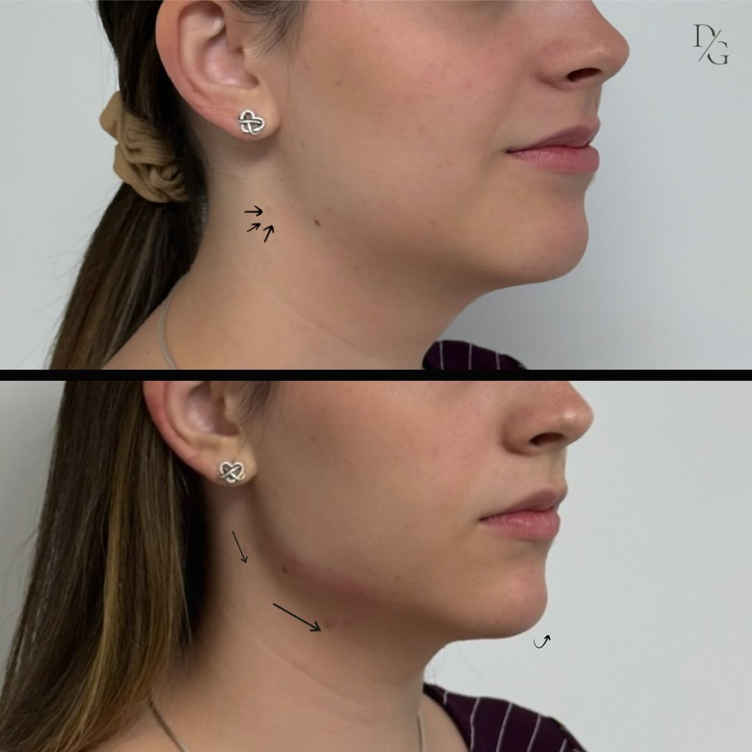 Antes y después de marcación mandibular en otra vista lateral