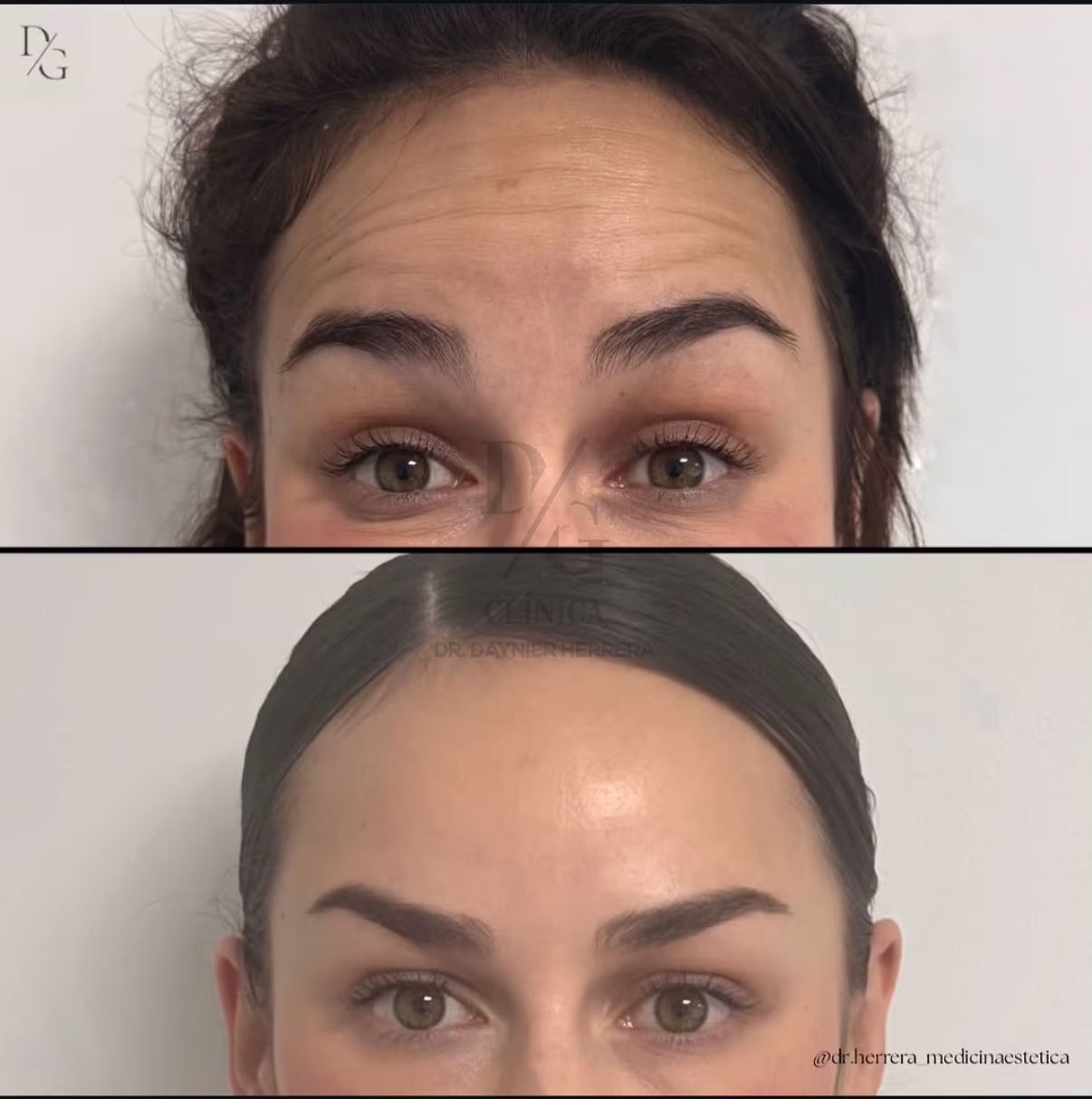 Antes y después de neuromoduladores