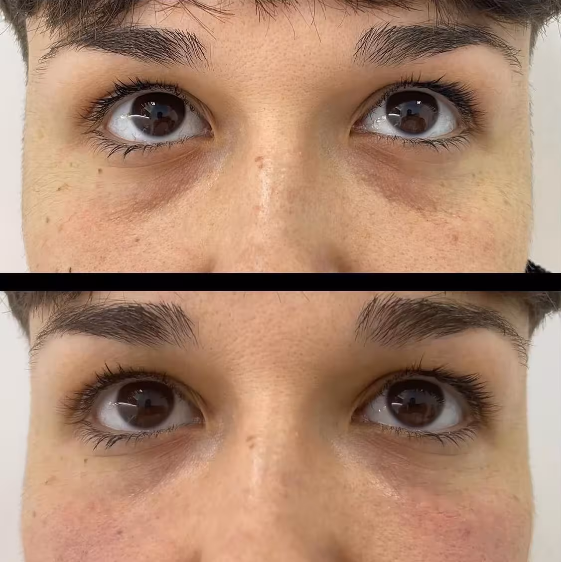 Tratamiento de Ojeras en clínica