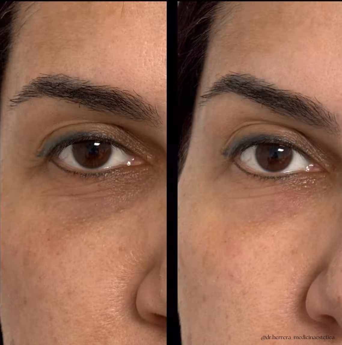 Antes y después de ojeras en vista lateral