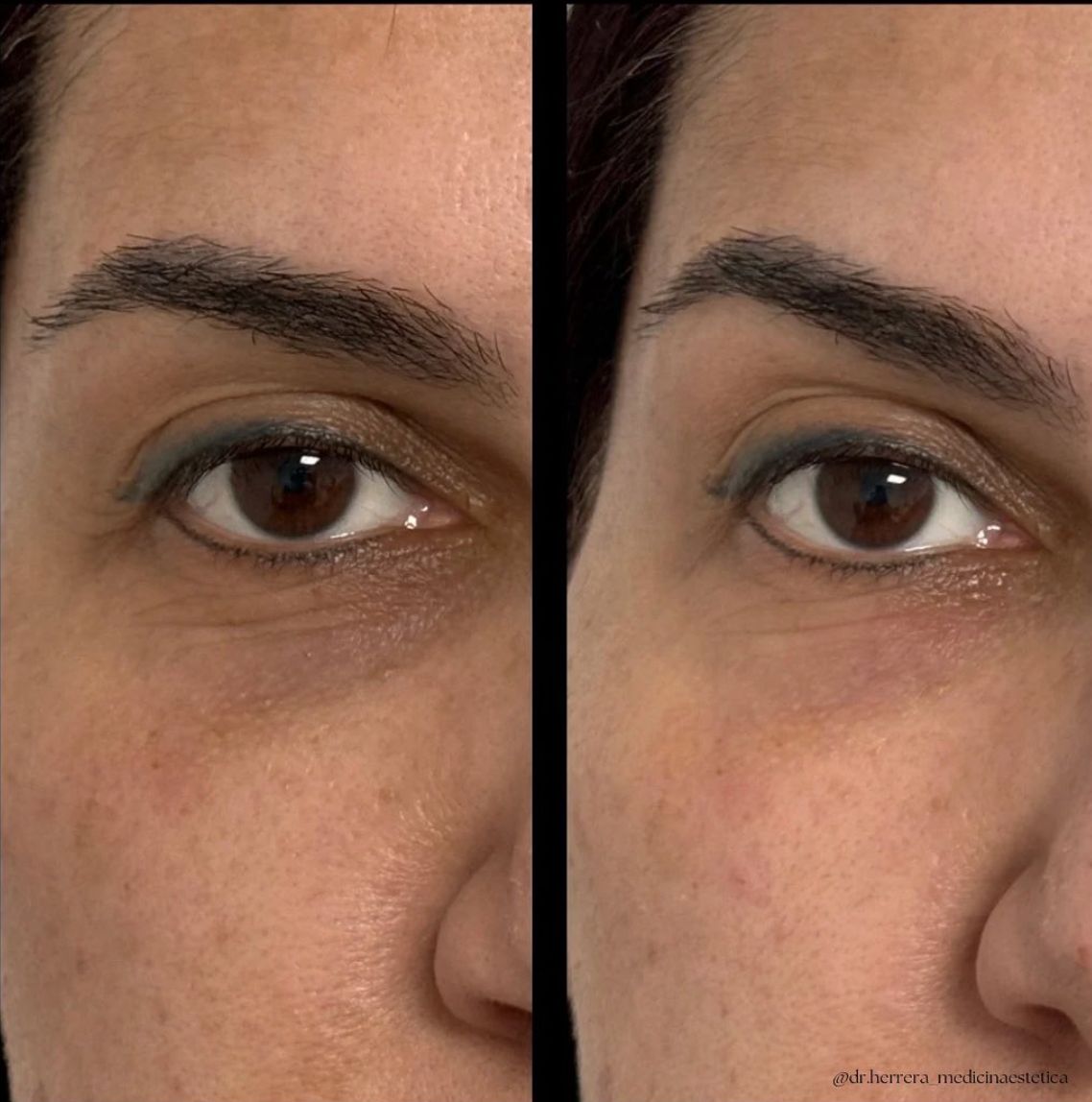 Antes y después de ojeras en vista lateral