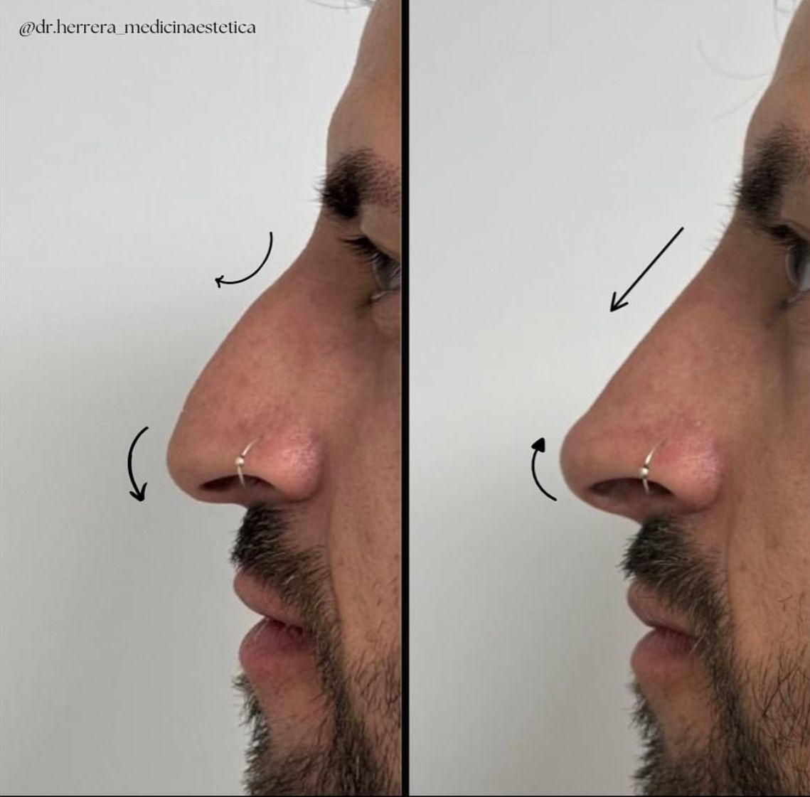 Antes y después de rinomodelación en vista frontal