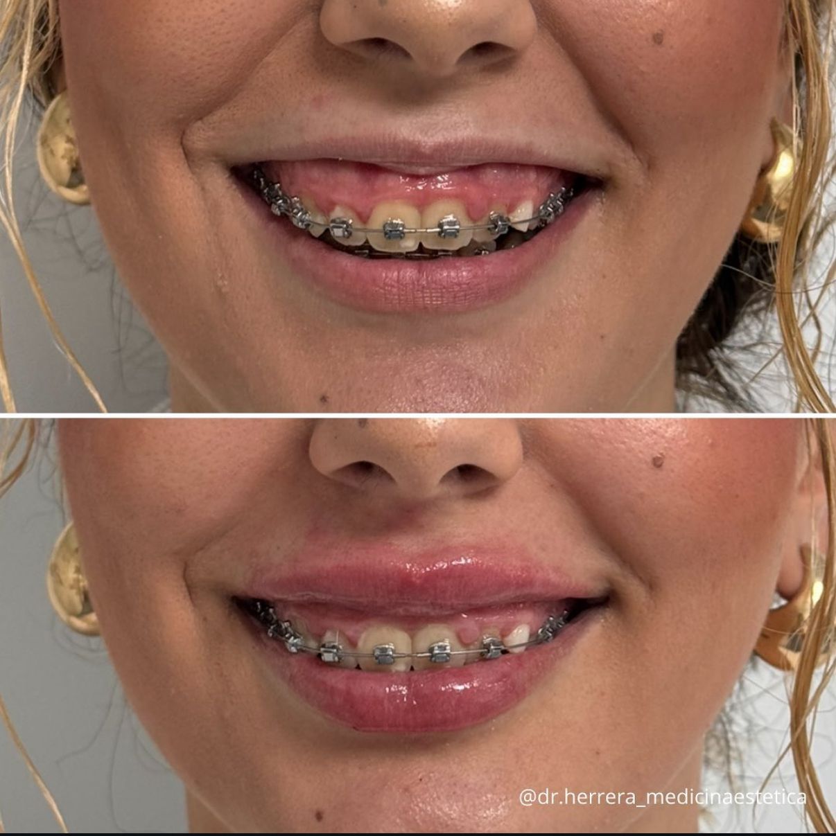 Antes y después de sonrisa gingival
